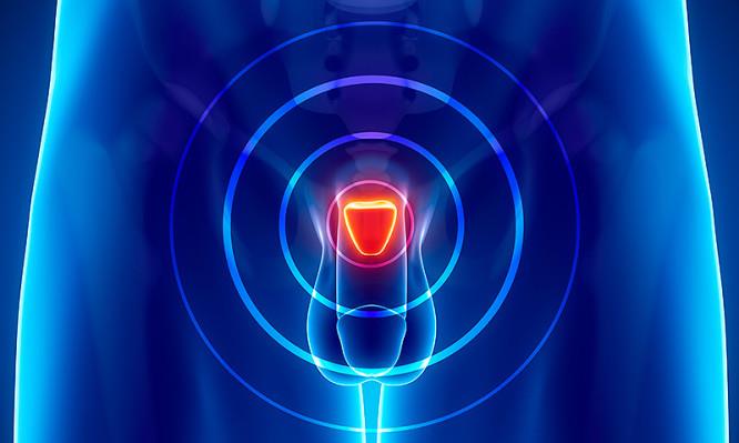 Prostate cancer concept